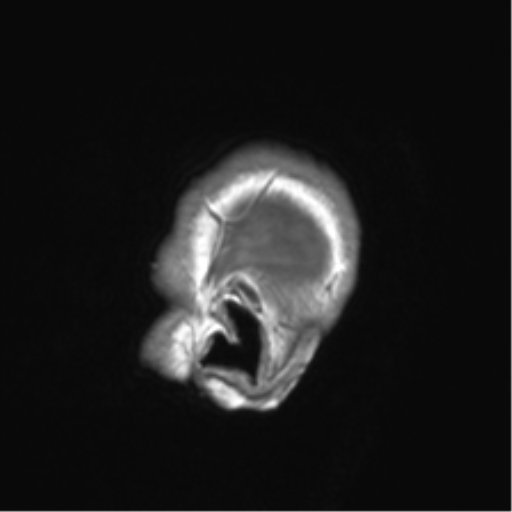 Clival chordoma invading the hypoglossal canal (Radiopaedia 48850-53887 Sagittal T1 89).png