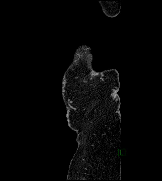Closed-loop small bowel obstruction-internal hernia (Radiopaedia 78439-91096 C 141).jpg