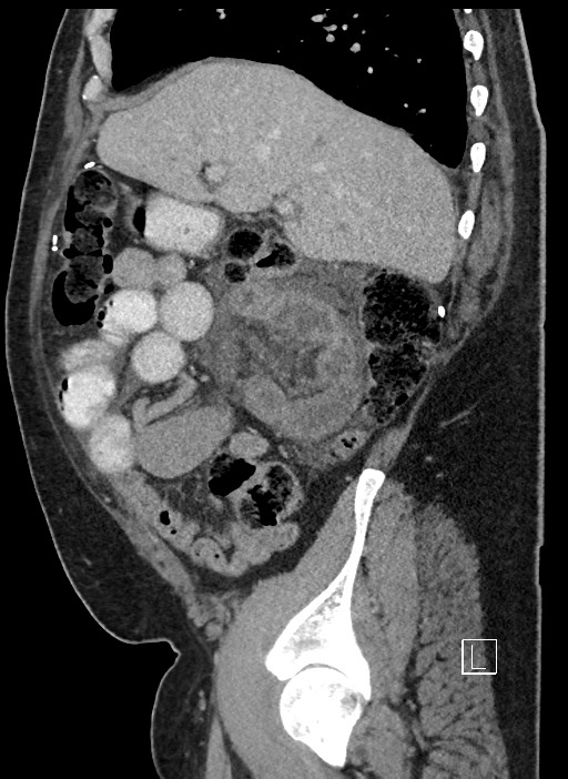 Closed loop obstruction - internal hernia into nephrectomy bed (Radiopaedia 59867-67320 C 76).jpg