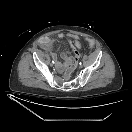 Closed loop obstruction due to adhesive band, resulting in small bowel ischemia and resection (Radiopaedia 83835-99023 B 124).jpg