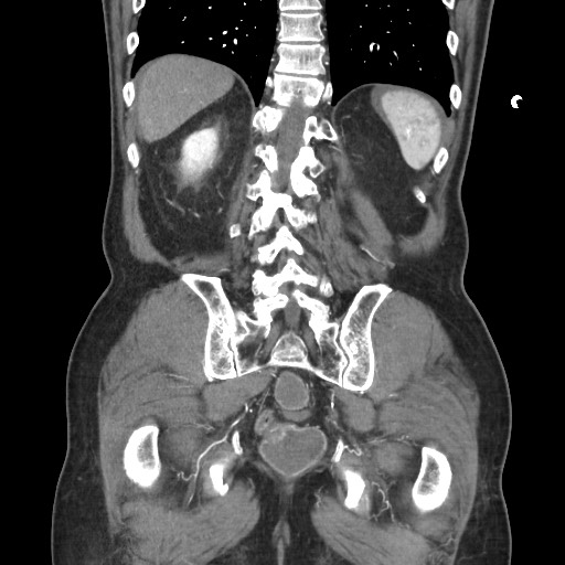 File:Closed loop obstruction due to adhesive band, resulting in small bowel ischemia and resection (Radiopaedia 83835-99023 C 97).jpg