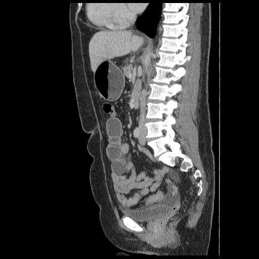 Closed loop small bowel obstruction (Radiopaedia 65403-74451 C 49).jpg