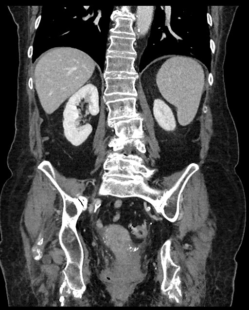 Closed loop small bowel obstruction - adhesions (Radiopaedia 59269-66611 B 85).jpg