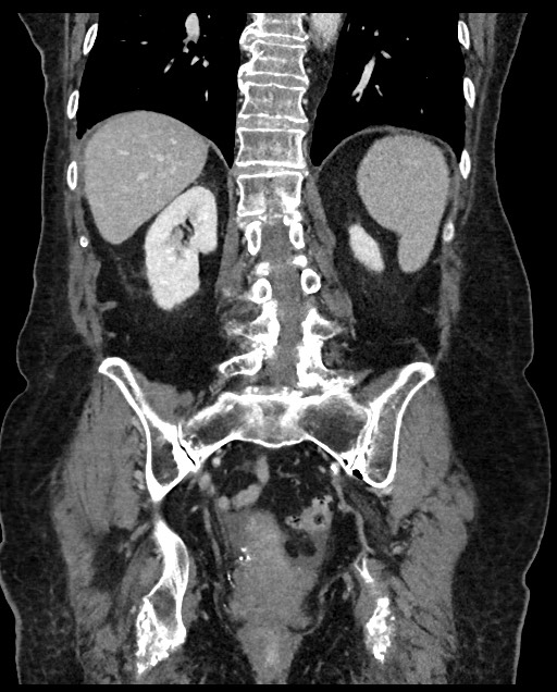 Closed loop small bowel obstruction - adhesions (Radiopaedia 59269-66611 B 89).jpg