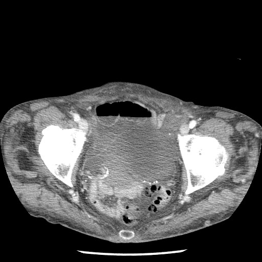 Closed loop small bowel obstruction - adhesions and infarct (Radiopaedia 85125-100678 B 95).jpg