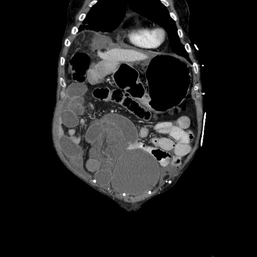 Closed loop small bowel obstruction - adhesive disease and hemorrhagic ischemia (Radiopaedia 86831-102990 B 35).jpg