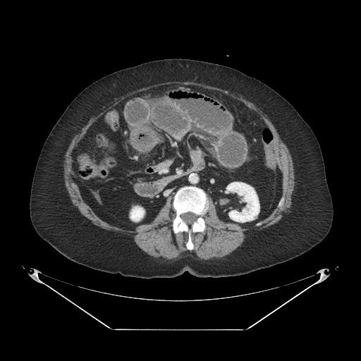 Closed loop small bowel obstruction - internal hernia (Radiopaedia 65402-74450 A 59).jpg