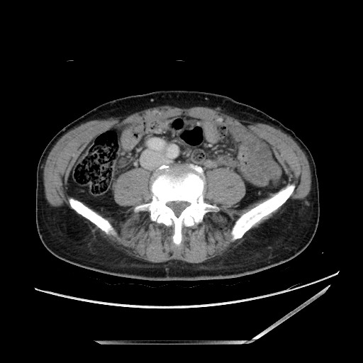 Closed loop small bowel obstruction - omental adhesion causing "internal hernia" (Radiopaedia 85129-100682 A 104).jpg