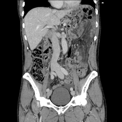 File:Closed loop small bowel obstruction - omental adhesion causing "internal hernia" (Radiopaedia 85129-100682 B 61).jpg