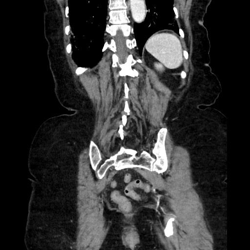 File:Closed loop small bowel obstruction due to adhesive band, with intramural hemorrhage and ischemia (Radiopaedia 83831-99017 C 100).jpg