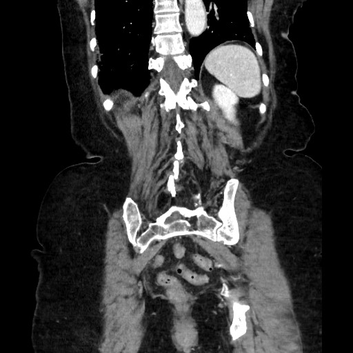Closed loop small bowel obstruction due to adhesive band, with intramural hemorrhage and ischemia (Radiopaedia 83831-99017 C 98).jpg