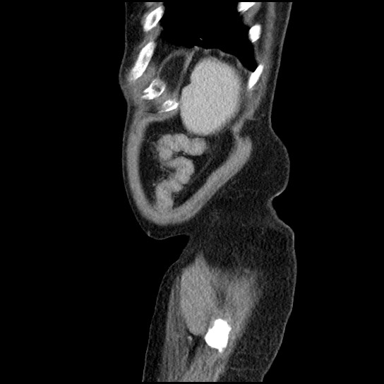 Closed loop small bowel obstruction due to adhesive band - U-shaped loop (Radiopaedia 83829-99012 C 9).jpg