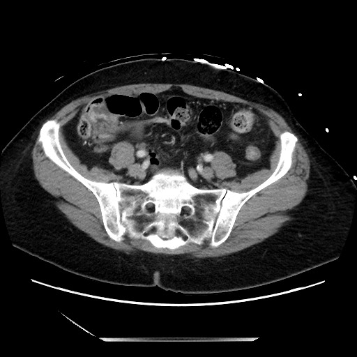 Closed loop small bowel obstruction due to adhesive bands - early and late images (Radiopaedia 83830-99014 A 110).jpg