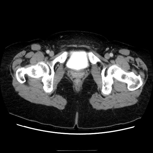 Closed loop small bowel obstruction due to adhesive bands - early and late images (Radiopaedia 83830-99015 A 167).jpg