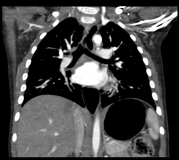 File:Coarctation of aorta (Radiopaedia 27427-27622 Coronal C+ CTPA 55).png