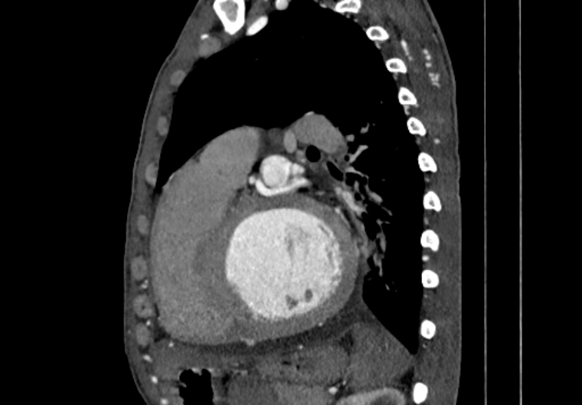 Coarctation of aorta with aortic valve stenosis (Radiopaedia 70463-80574 B 116).jpg