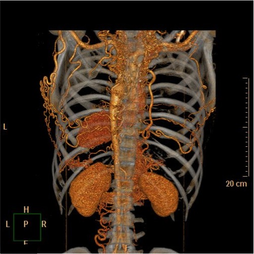 File:Coarctation of the aorta (Radiopaedia 40877-43571 A 6).jpg