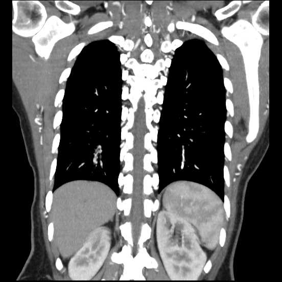 File:Coarctation of the aorta (Radiopaedia 67609-77010 B 17).jpg