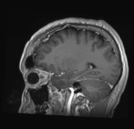 Cochlear incomplete partition type III associated with hypothalamic hamartoma (Radiopaedia 88756-105498 Sagittal T1 C+ 18).jpg