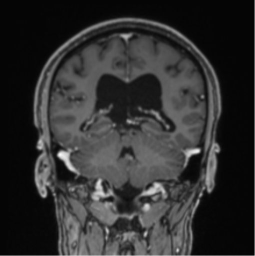 File:Colloid cyst of the third ventricle (Radiopaedia 86571-102662 Coronal T1 C+ 37).png