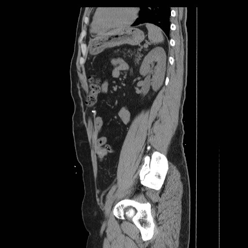 File:Colocutaneous fistula in Crohn's disease (Radiopaedia 29586-30093 C 41).jpg