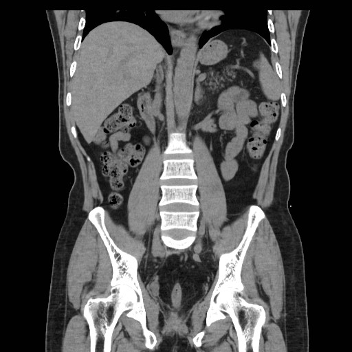 File:Colocutaneous fistula in Crohn's disease (Radiopaedia 29586-30093 Coronal non-contrast 22).jpg
