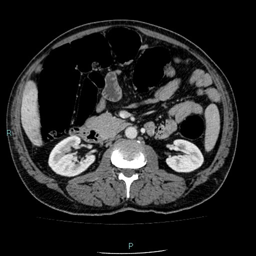 Colon adenocarcinoma with calcific liver metastasis (Radiopaedia 55745-62300 B 18).jpg