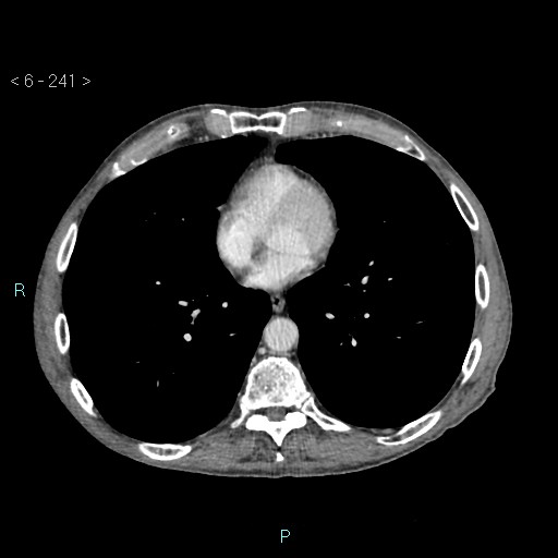 Colonic cancer (ultrasound and TC imaging) (Radiopaedia 50346-55713 B 241).jpg