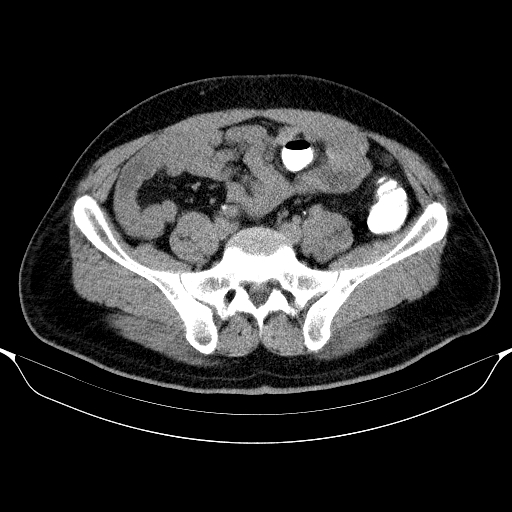 File:Colonic lipoma with colo-colic intussusception (Radiopaedia 58944-66200 Axial C+ rectal 50).jpg