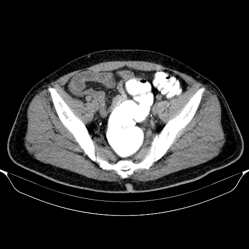 Colonic lipoma with colo-colic intussusception (Radiopaedia 58944-66200 Axial C+ rectal 59).jpg
