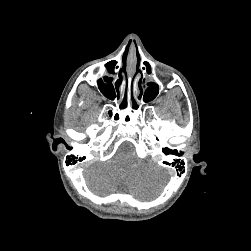 Nasal pyogenic granuloma (lobular capillary hemangioma) (Radiopaedia 85536-101244 C 80).jpg