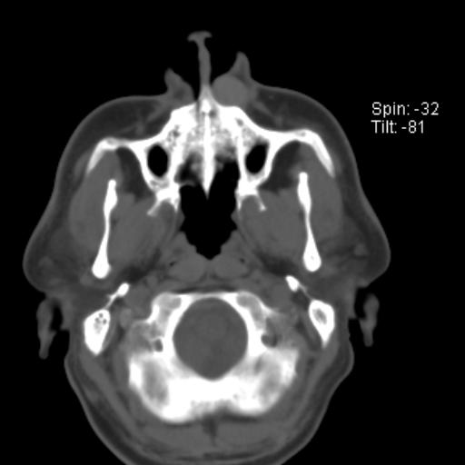 File:Nasolabial cyst (Radiopaedia 28401-28650 Axial bone window 1).jpg