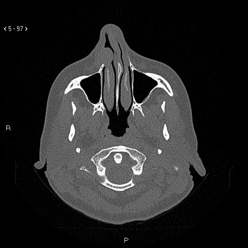 Nasolabial cyst (Radiopaedia 75125-86194 Axial bone window 58).jpg
