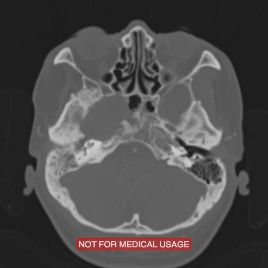 Nasopharyngeal carcinoma recurrence - skull base destruction (Radiopaedia 29107-29490 Axial bone window 84).jpg