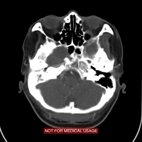 File:Nasopharyngeal carcinoma recurrence - skull base destruction (Radiopaedia 29107-29491 A 6).jpg