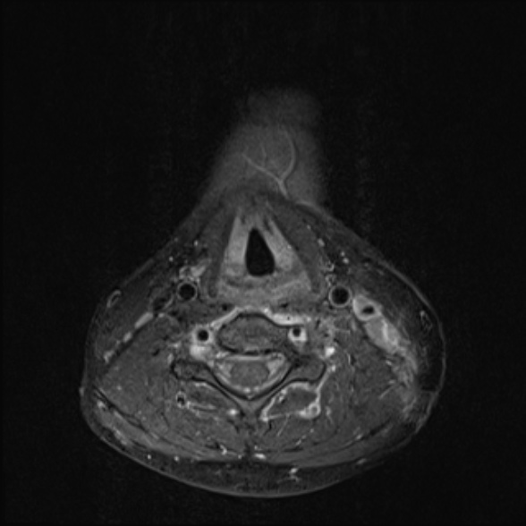 Nasopharyngeal carcinoma with skull base invasion (Radiopaedia 53415-59485 Axial T1 C+ fat sat 56).jpg