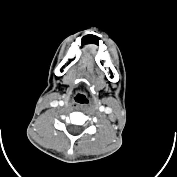 Nasopharyngeal carcinoma with skull base invasion (Radiopaedia 53415-59705 A 131).jpg