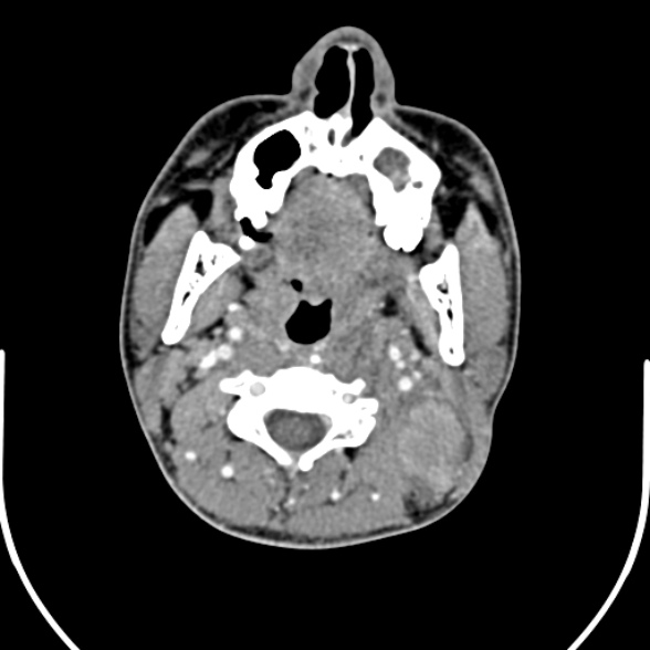 Nasopharyngeal carcinoma with skull base invasion (Radiopaedia 53415-59705 A 85).jpg