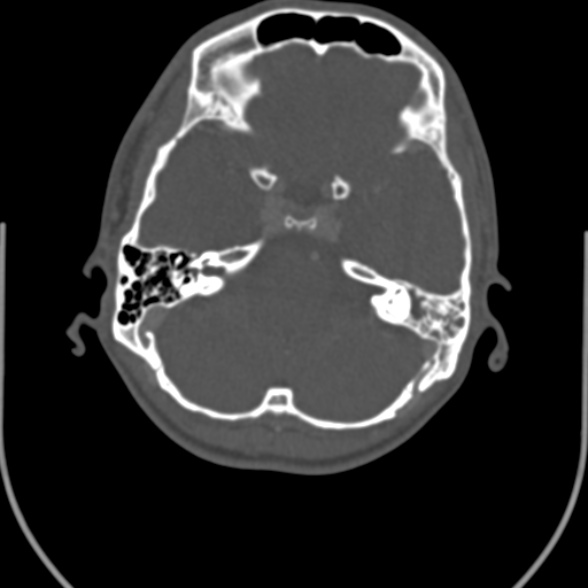Nasopharyngeal carcinoma with skull base invasion (Radiopaedia 53415-59705 Axial bone window 5).jpg