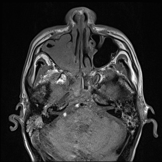 Nasopharyngeal carcinoma with skull base invasion (Radiopaedia 59258-66600 B 14).jpg