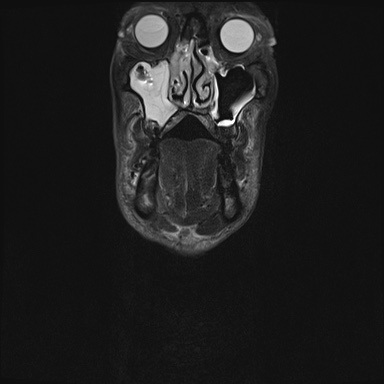 Nasopharyngeal carcinoma with skull base invasion (Radiopaedia 59258-66600 Coronal T2 fat sat 34).jpg