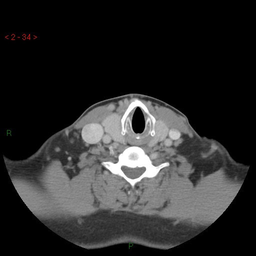 File:Nasopharyngeal lymphoma (Radiopaedia 54235-60433 A 7).jpg