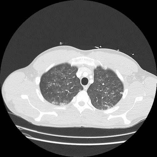 Near-drowning pulmonary edema (Radiopaedia 59457-66814 Axial lung window 12).jpg
