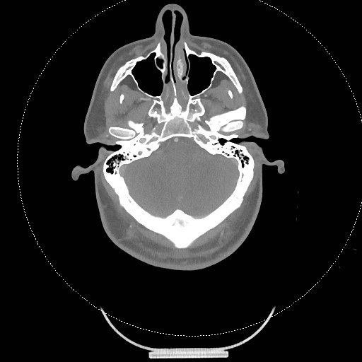 Neck CT angiogram (intraosseous vascular access) (Radiopaedia 55481-61945 B 266).jpg