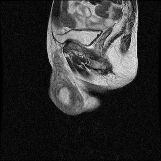 File:Necrotizing epididymo-orchitis with intra-testicular abscess (Radiopaedia 29397-29860 Sagittal T2 14).jpg
