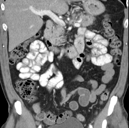 File:Necrotizing pancreatitis with acute necrotic collection (Radiopaedia 14470-14417 C 17).jpg