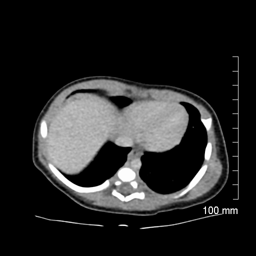File:Neonatal neuroblastoma (Radiopaedia 56651-63438 Axial non-contrast 12).jpg