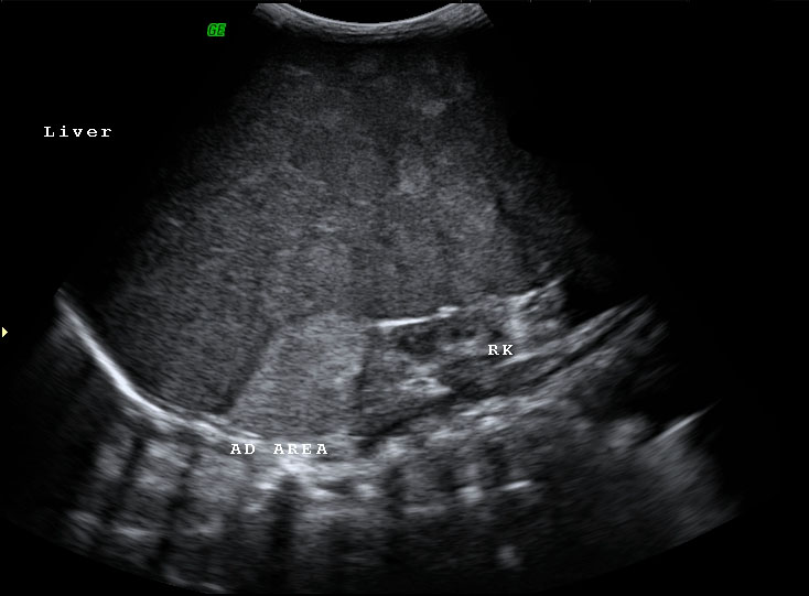 File:Neonatal neuroblastoma (Radiopaedia 9564-10221 A 2).jpg