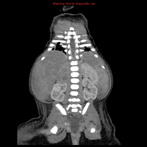 File:Neonatal neuroblastoma (Radiopaedia 9564-10223 B 93).jpg