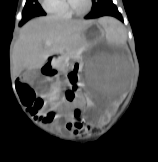 Nephroblastomatosis (Radiopaedia 71294-81607 B 151).jpg